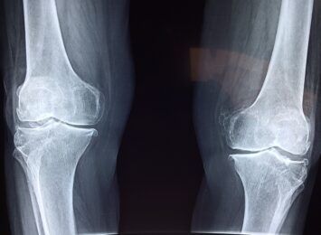 Osteoporoza - bezpłatne badania dla mieszkańców Żor